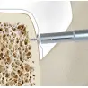 Pinject Smart Kit pins (vis) d'ostéosynthèse en titane