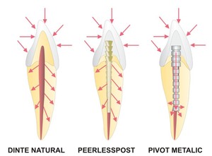 peerlesspost_comparatie.jpg