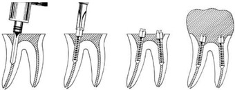 pivoti_endodontici_utilizare.jpg