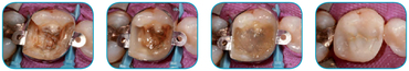 everx-posterior-clinic1.jpg