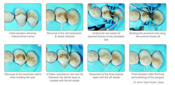 g-aenial-injectable-clasa-ii.jpg