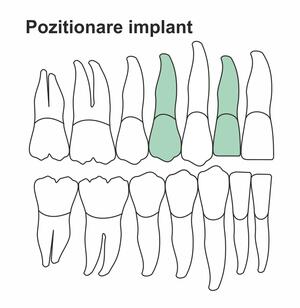 pozitionare-implant-ia-34.jpg