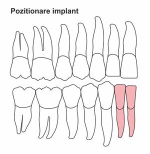 pozitionare-implant-ic-30.jpg