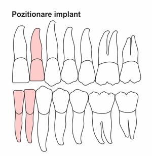 pozitionare-implant-ic-34.jpg