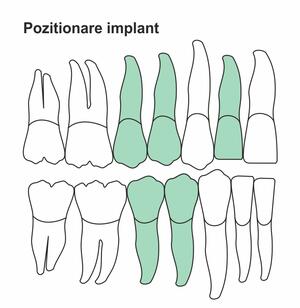 pozitionare-implant-ic-38.jpg