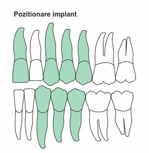 pozitionare-implant-ic-42.jpg