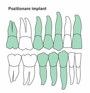 pozitionare-implant-ic-46.jpg