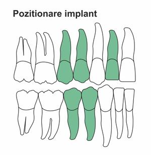 pozitionare-implant-ik-38-ht.jpg