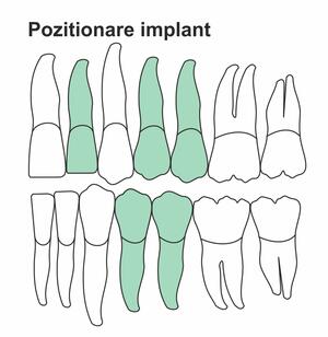 pozitionare-implant-ik-38.jpg