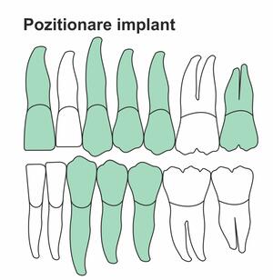 pozitionare-implant-ik-46-ht.jpg