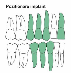 pozitionare-implant.jpg