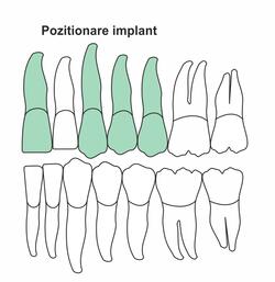 pozitionare-implant-ia-38.jpg