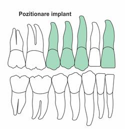 pozitionare-implant-ia-42.jpg