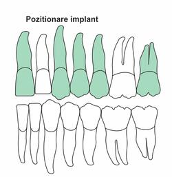 pozitionare-implant-ia-46.jpg