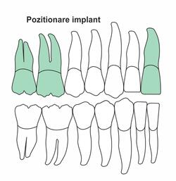 pozitionare-implant-ia-50.jpg