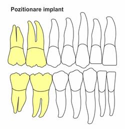 pozitionare-implant-ic-50.jpg