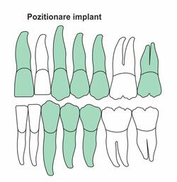 pozitionare-implant-ik-46.jpg