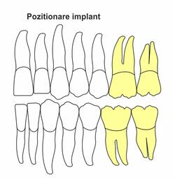 pozitionare-implant-ik-50.jpg